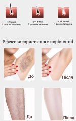 Лазерний епілятор — изображение 2